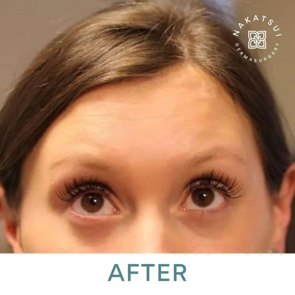 best Botox forehead lines after photo edmonton
