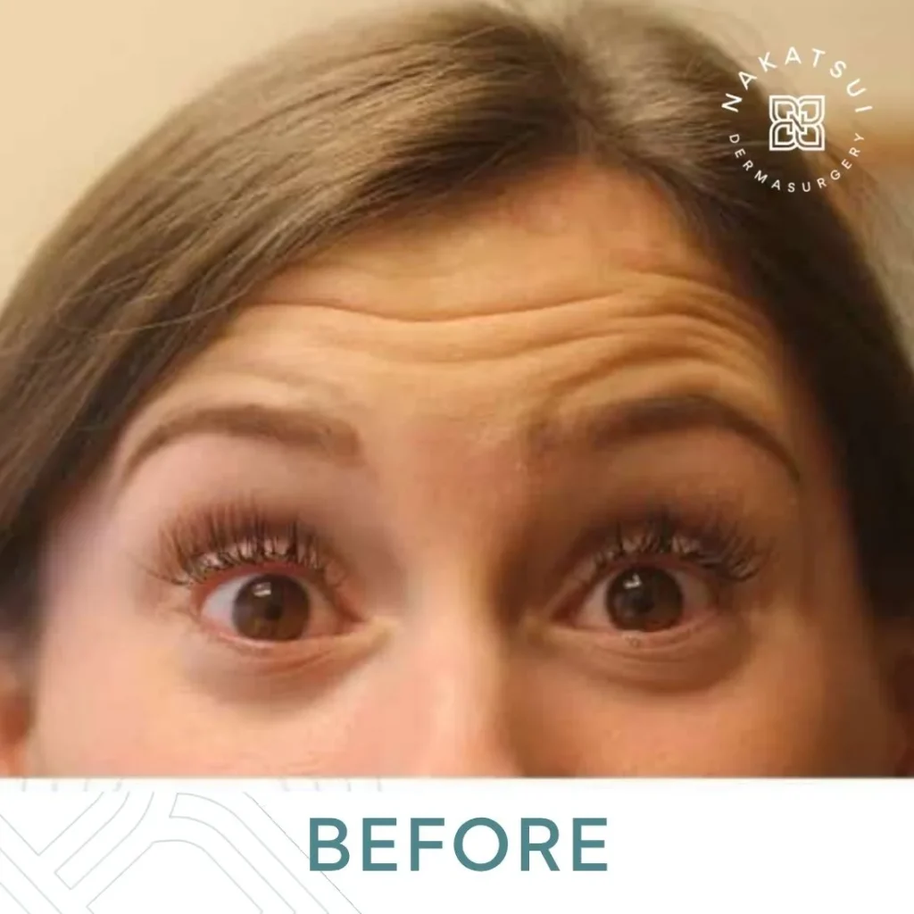 best Botox forehead lines before photo edmonton