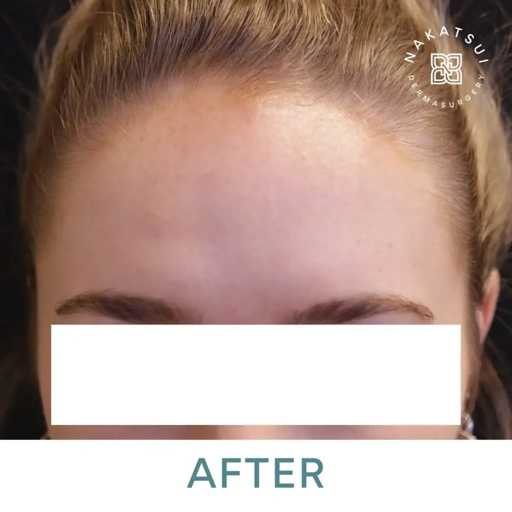 frown lines (glabella) after Botox Edmonton