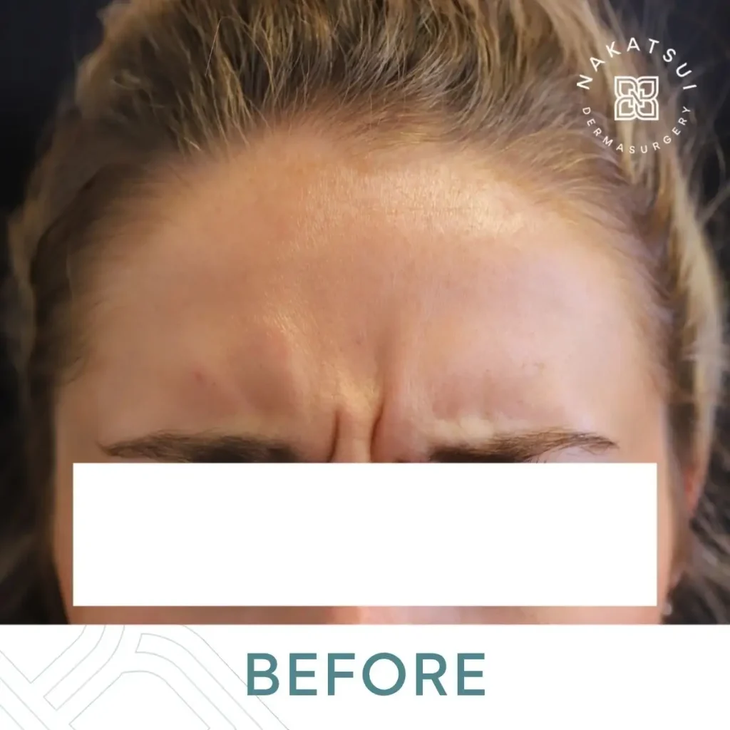 frown lines (glabella) before Botox Edmonton