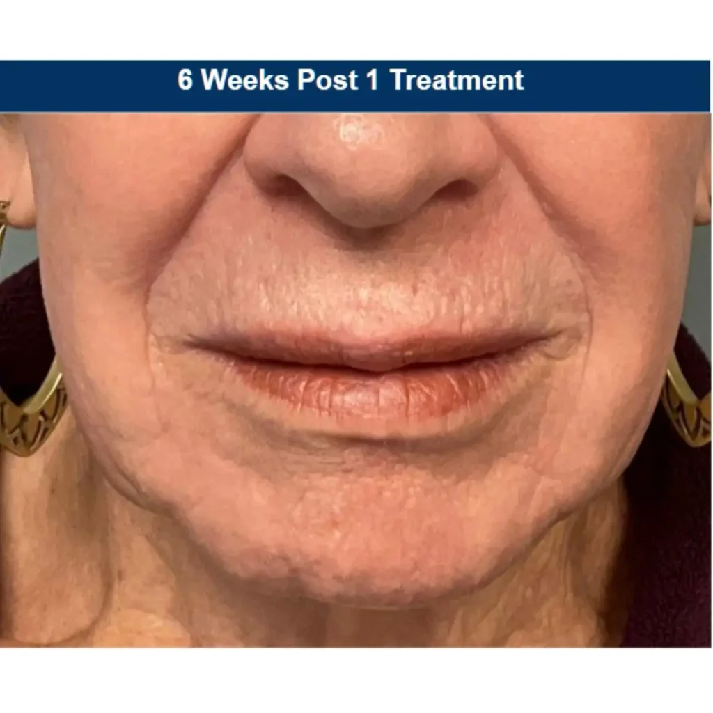 ultraclear laser resurfacing after photo with marked improvement of wrinkles