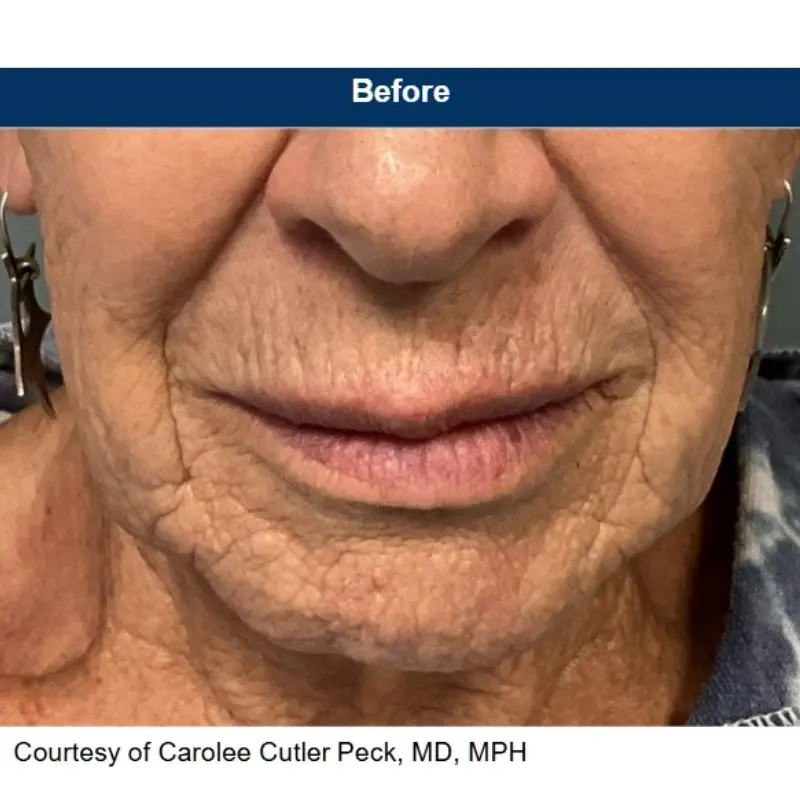 ultraclear laser resurfacing before edmonton