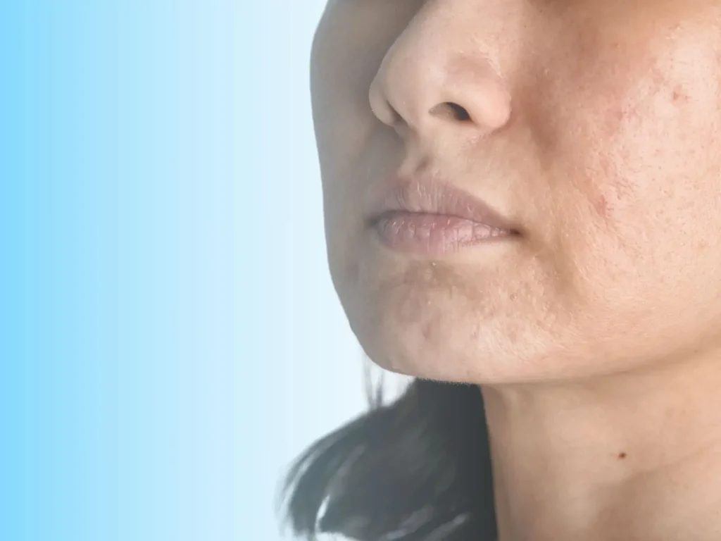 acne clinic edmonton