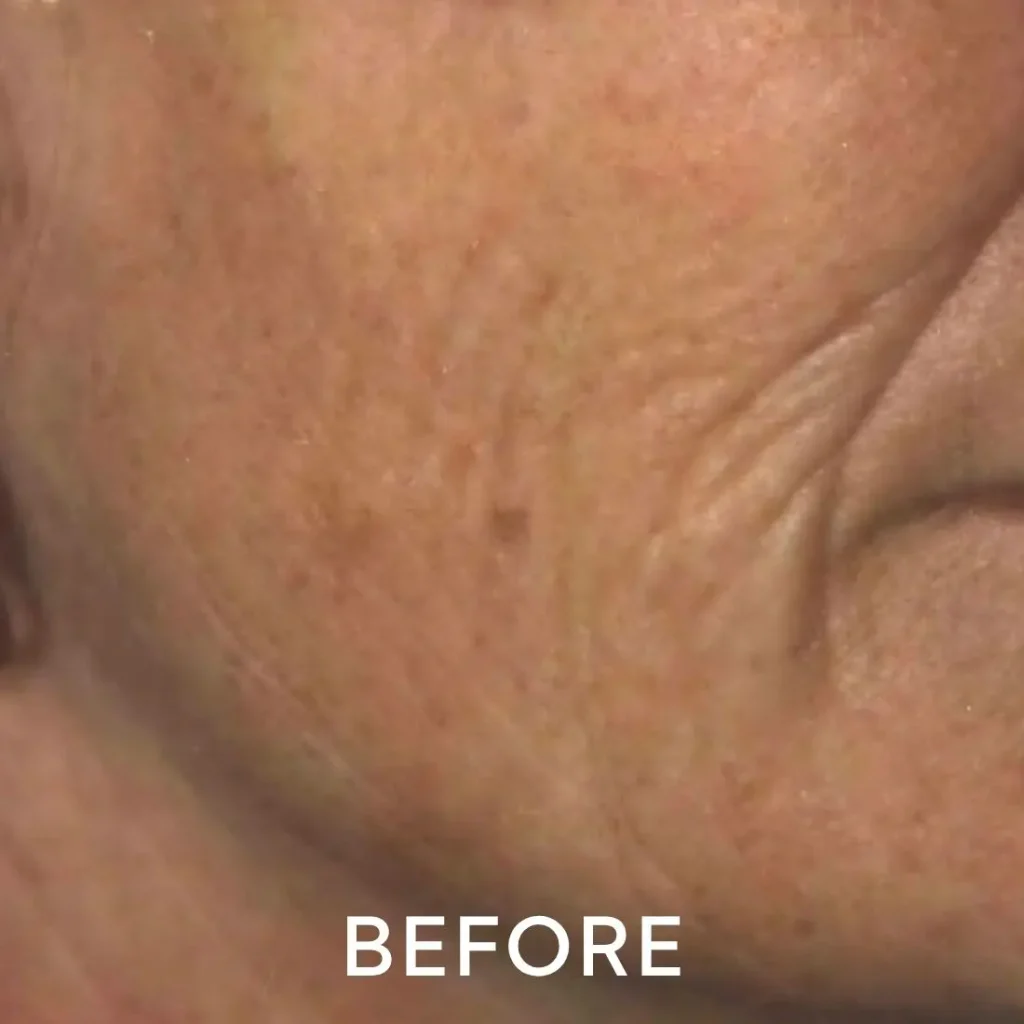 photo of cheek before laser resurfacing