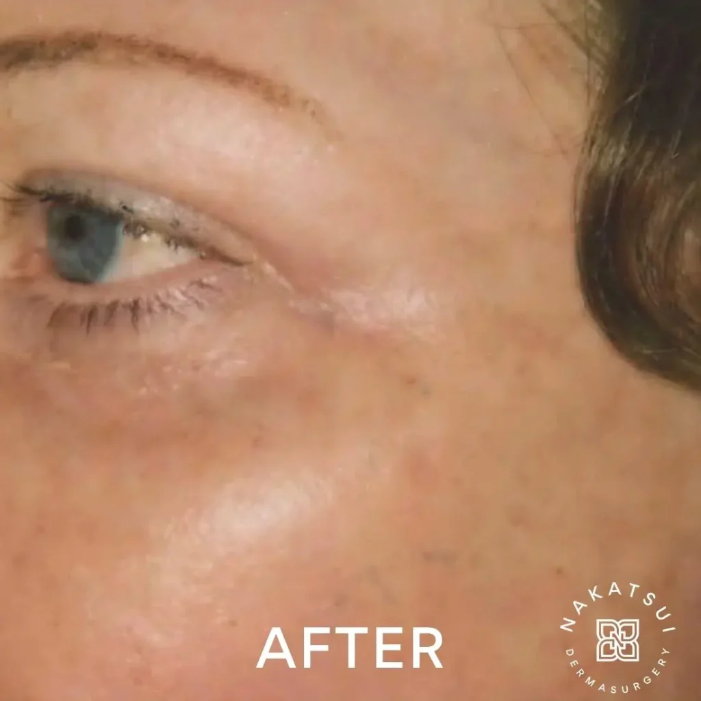 photo of eyes and periorbital area after laser resurfacing