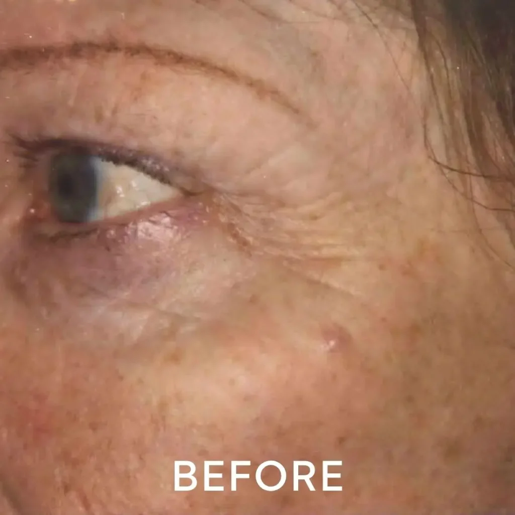 photo of eyes and periorbital area before laser resurfacing