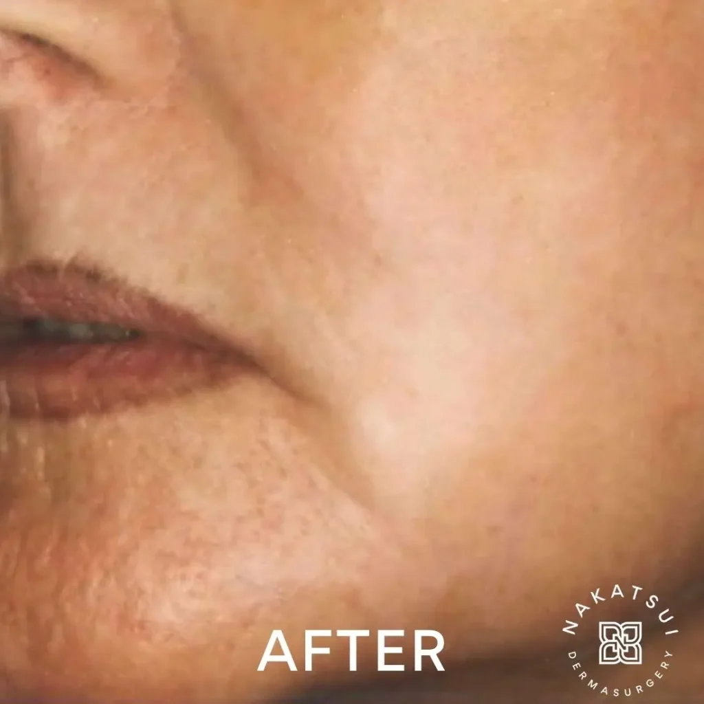 photo of left cheek after laser resurfacing