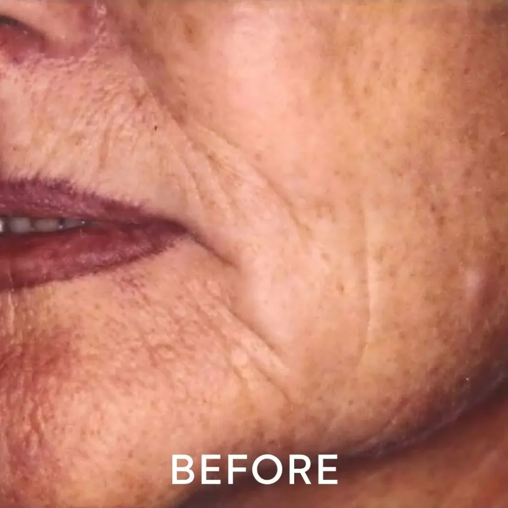 photo of left cheek before laser resurfacing