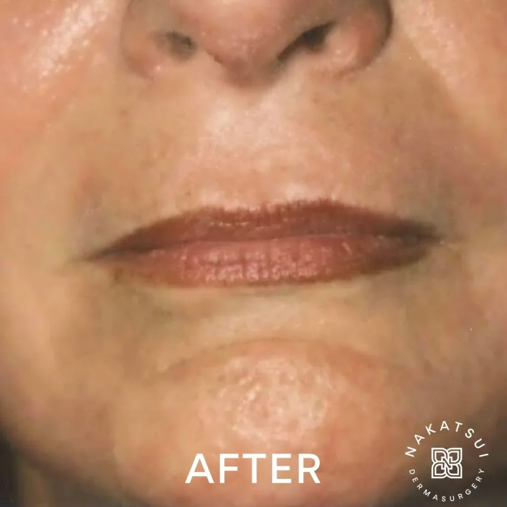 photo of perioral area (barcode lines) after laser resurfacing