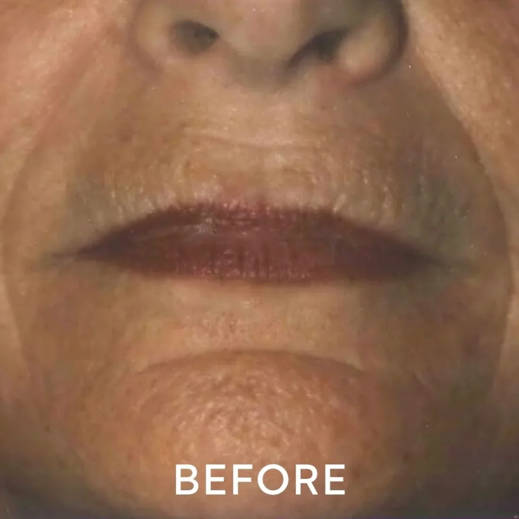 photo of perioral area (barcode lines) before laser resurfacing