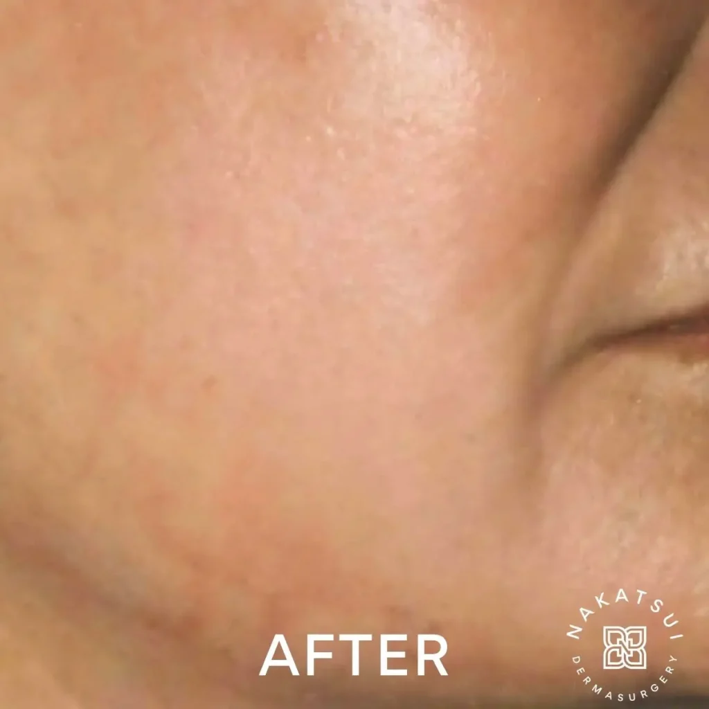 photo of cheek after laser resurfacing