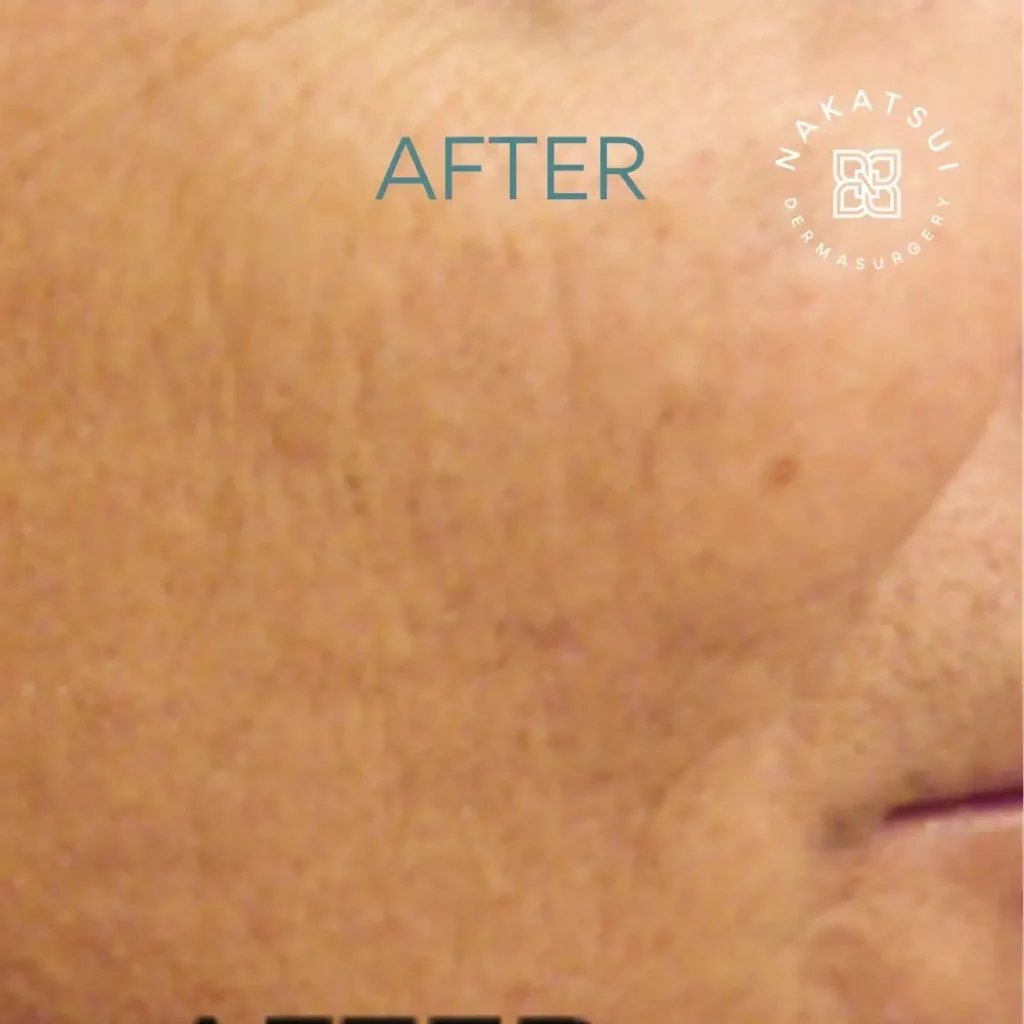 photo of acne scars after laser treatment