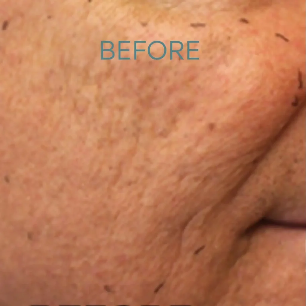 photo of acne scars before laser treatment