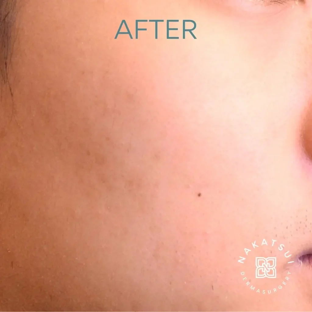 photo of acne scarring after morpheus8 treatment