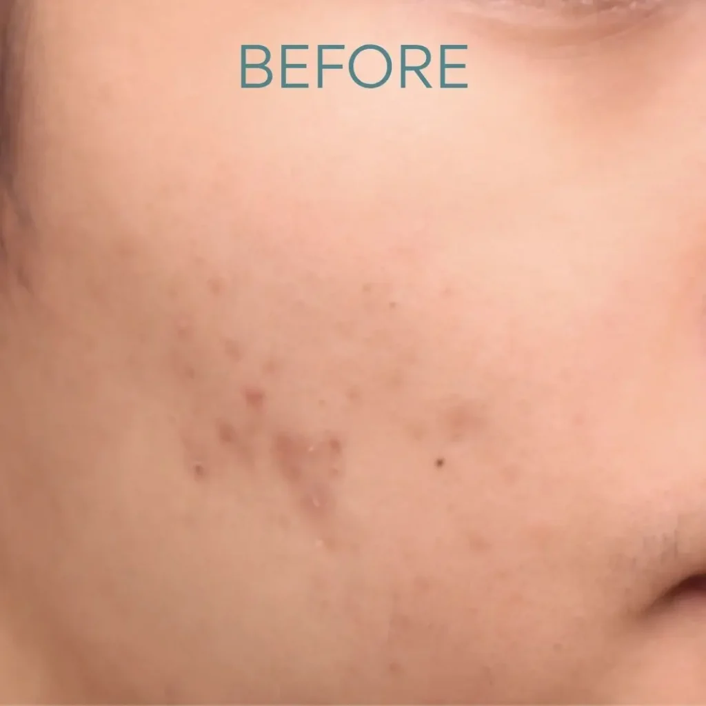 photo of acne scarring before morpheus8 treatment